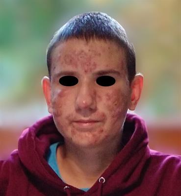 Acne fulminans treatment: case report and literature review